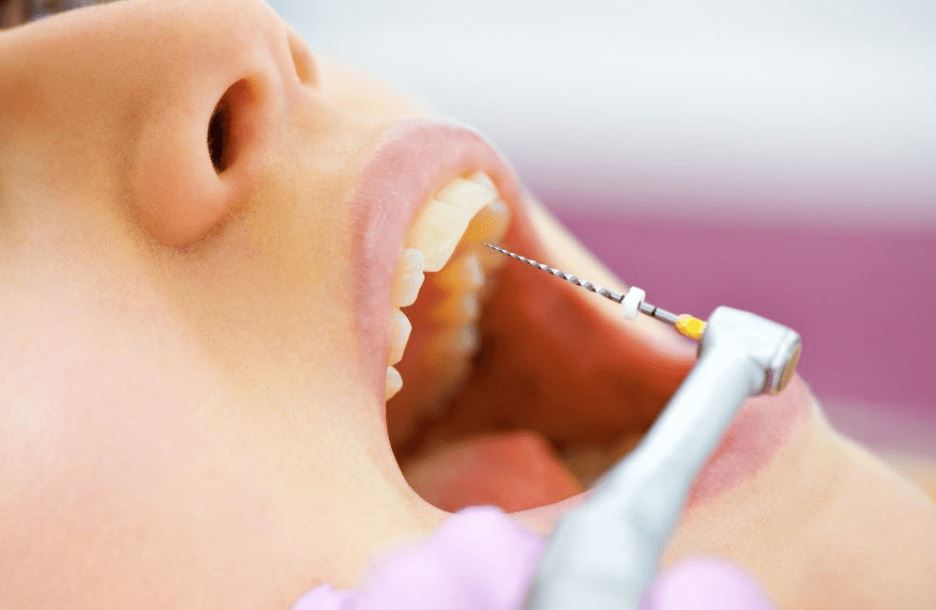 Do Root Canals Hurt