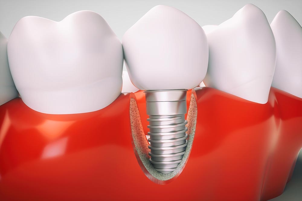 Bone grafting for tooth implants