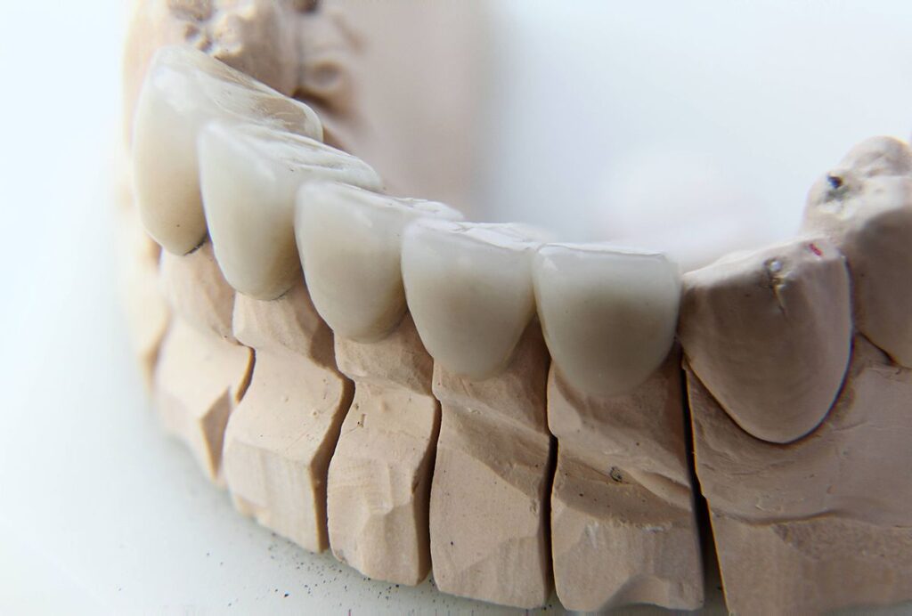 Broken, chipped, or cracked teeth