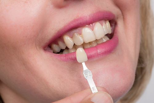 Dental Issues Crowns