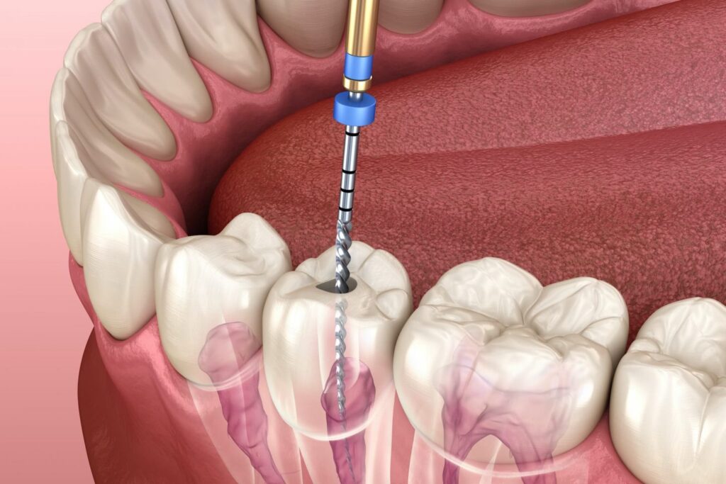Root Canal Therapy in Burnaby