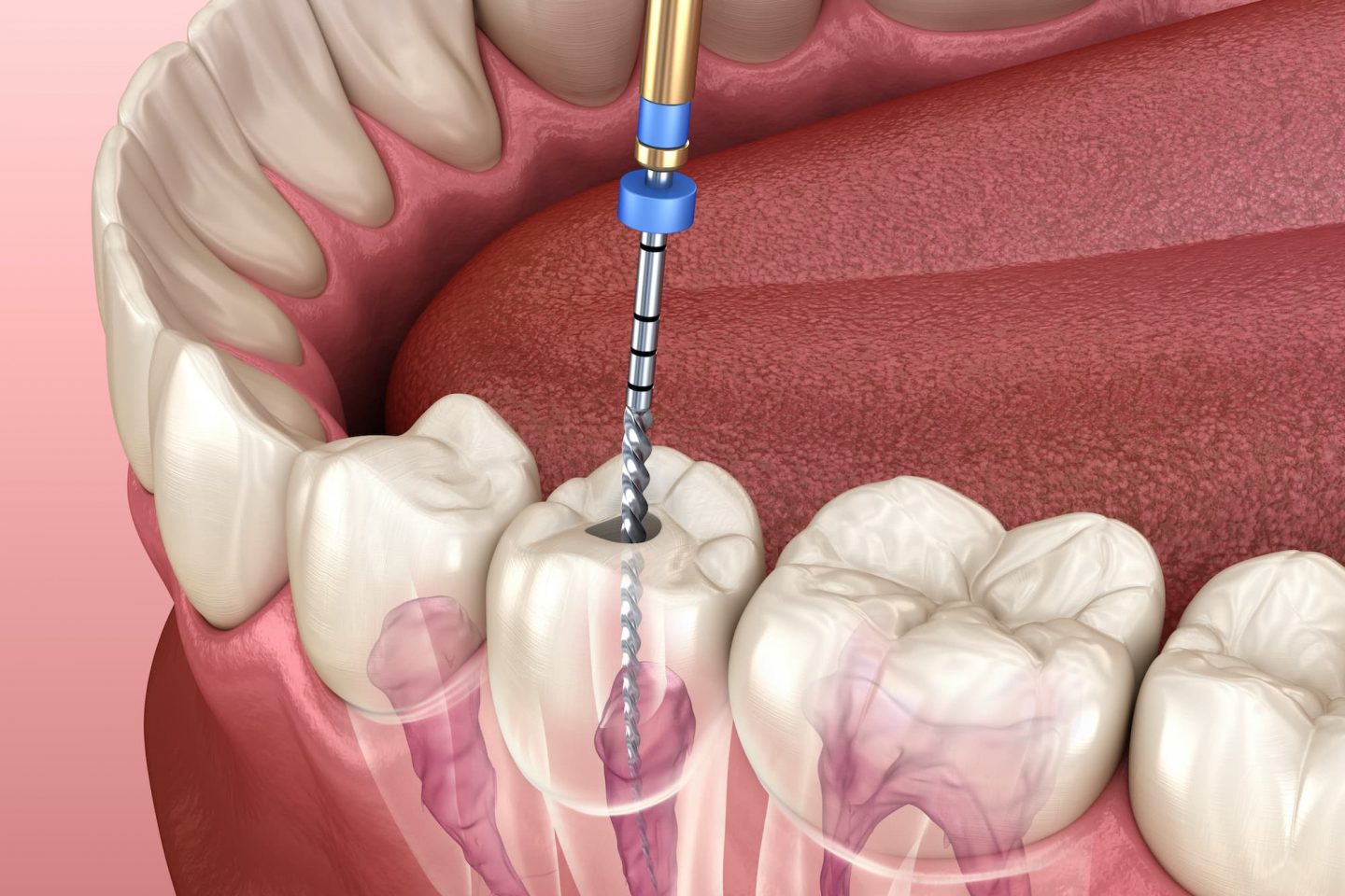 Root Canal Therapy in Burnaby
