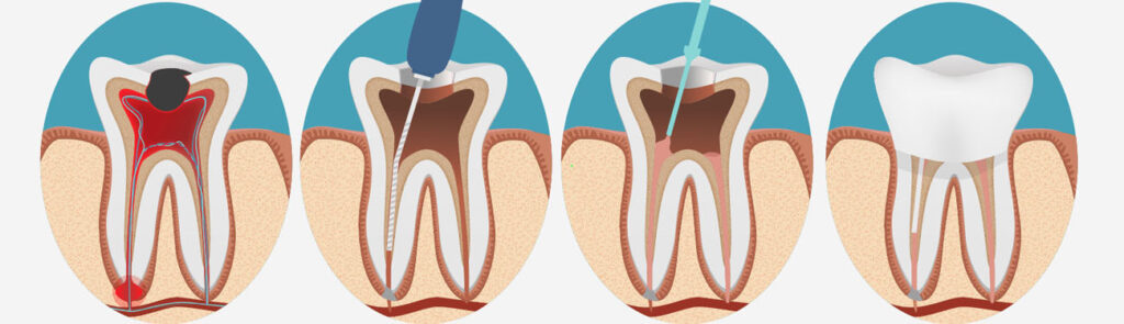 Root canal Treatment