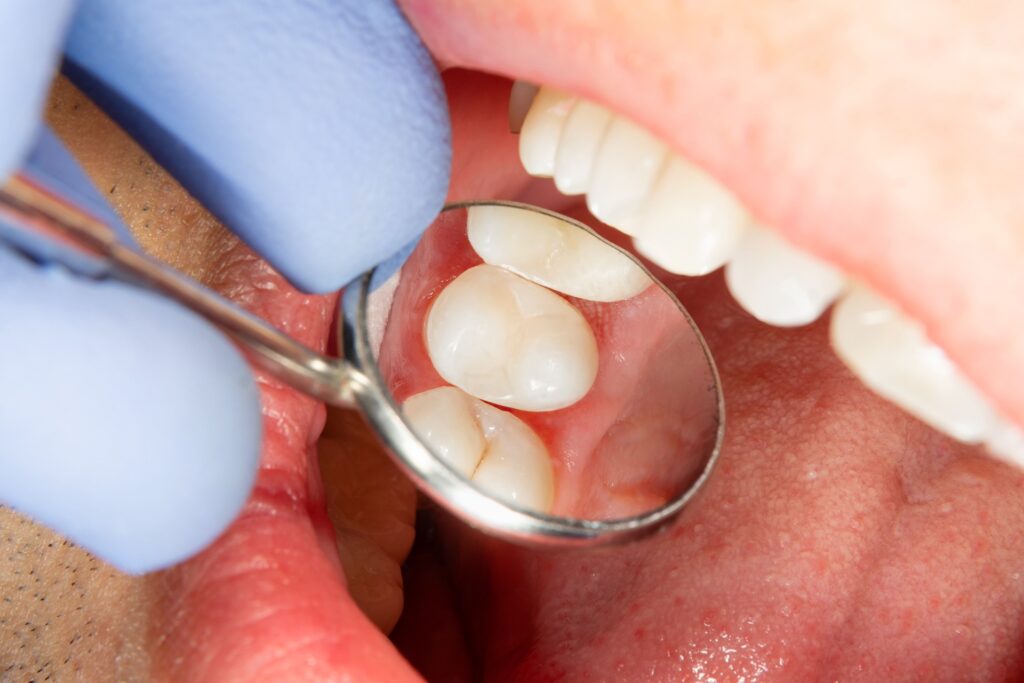 How Root Canal Therapy is Performed