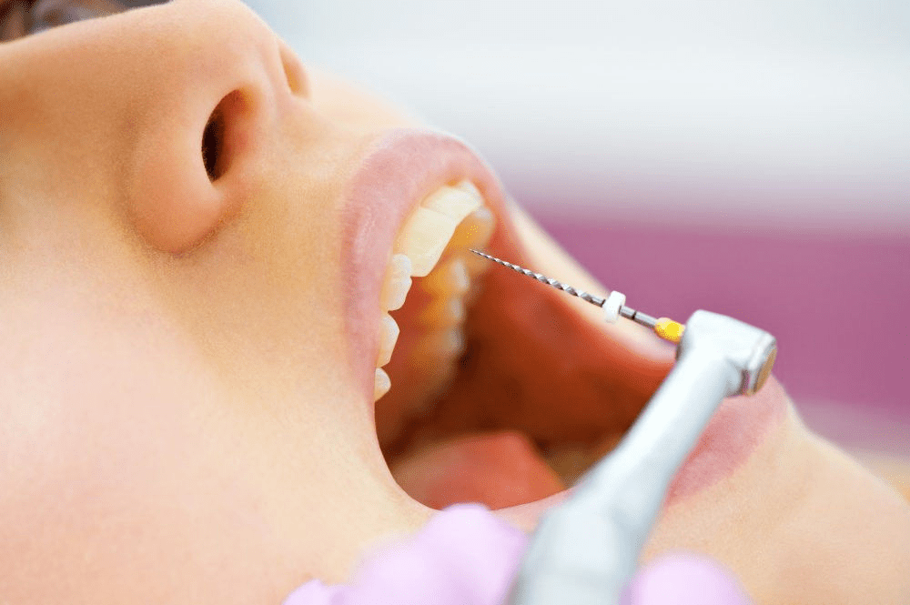 Modern Root Canal Therapy